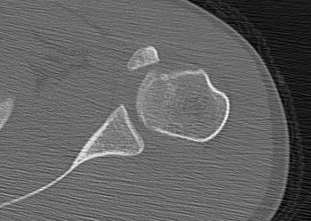 Lesser Tuberosity Fracture 2